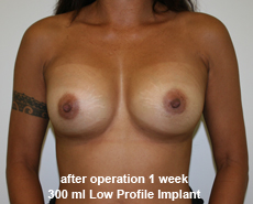 plastic-surgery-breast-augmentation